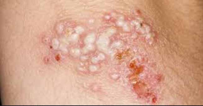 herpes outbreak stage, blisters